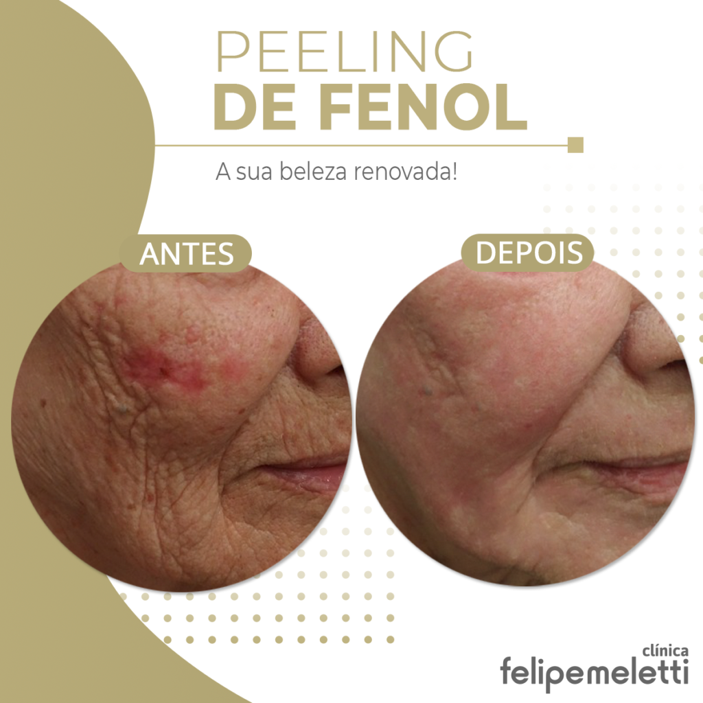 Peeling De Fenol Cl Nica Felipe Meletti