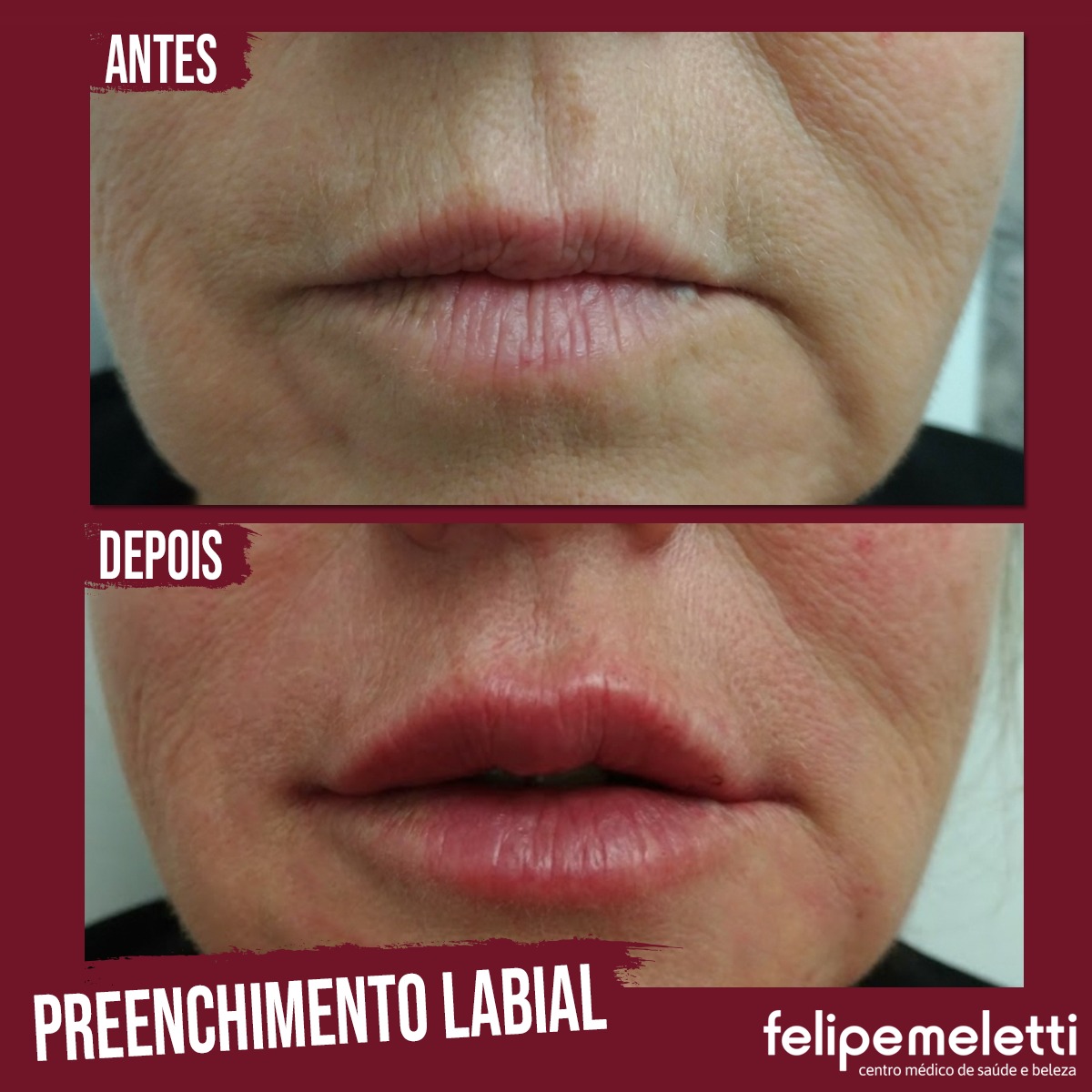 Preenchimento Labial Clínica Felipe Meletti