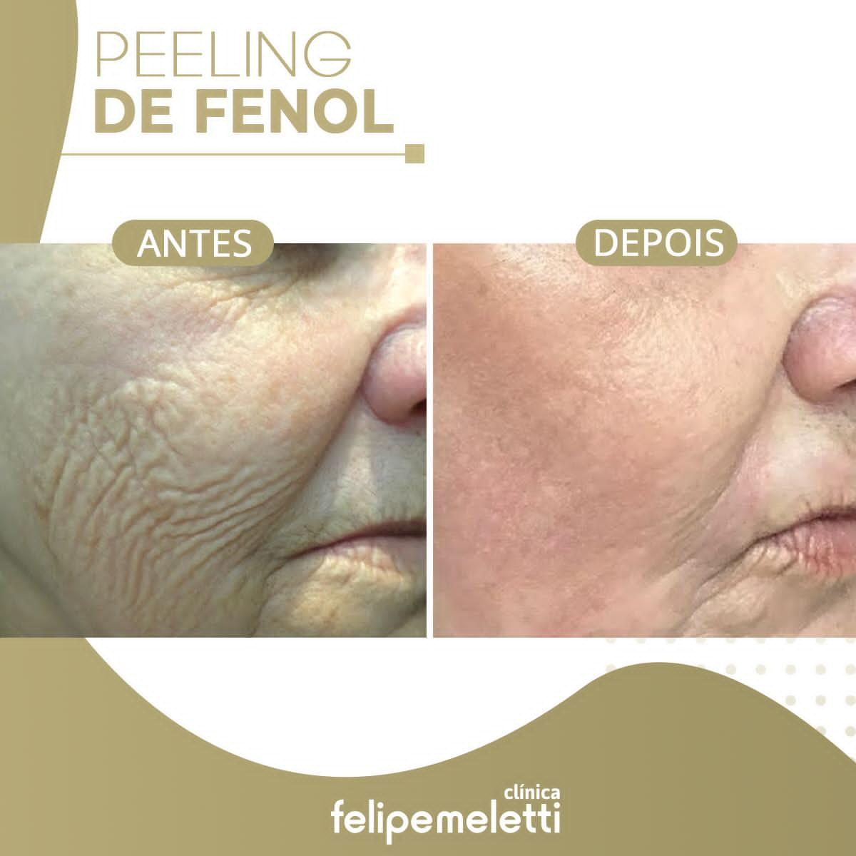 Peeling De Fenol Rejuvenes A At Anos Em Meses